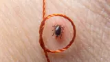 Как достать клеща у человека, если рядом нет врача: инструкция